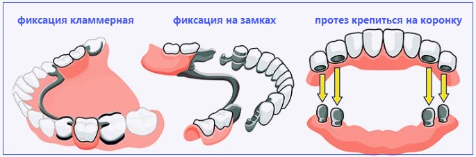 протезы съемные стоматологические бюгельные